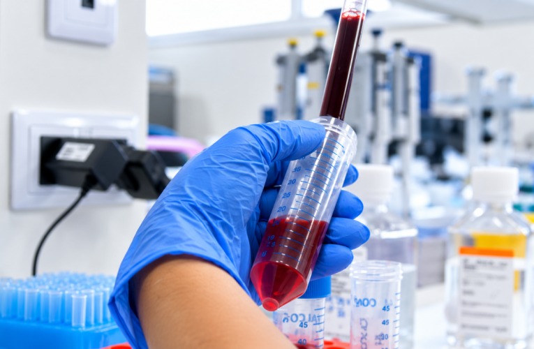 Una investigación liderada por el Hospital público 12 de Octubre identifica genes asociados al riesgo de desarrollar neumonitis en pacientes con cáncer de mama tratadas con un fármaco clave